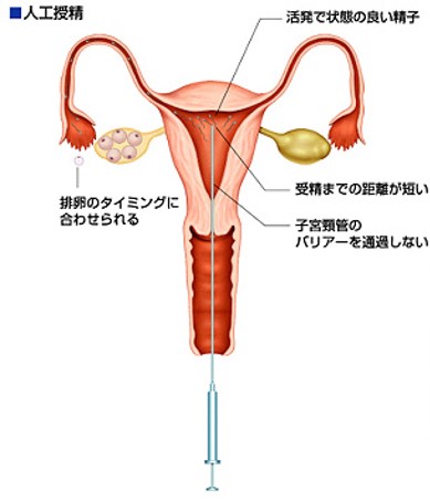 子宮口精子注射画像 